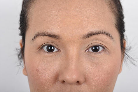 Double Eyelid Blepharoplasty