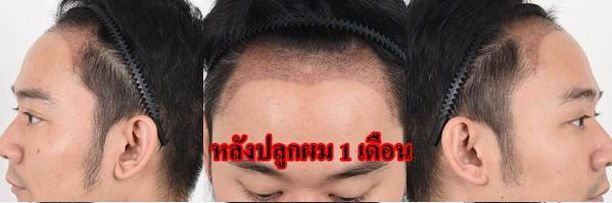 Hair Transplant