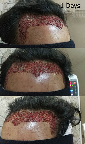 Hair Transplant