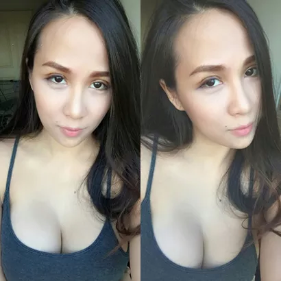 Double Eyelid Surgery