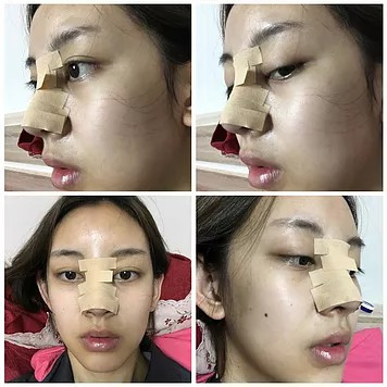 Rhinoplasty Korean