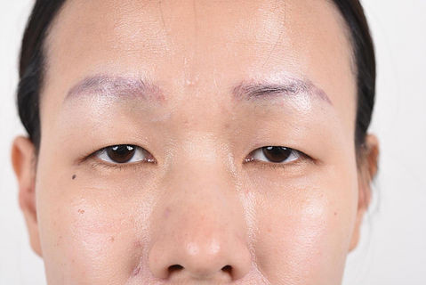 double eyelid