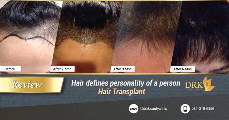 Hair Transplant