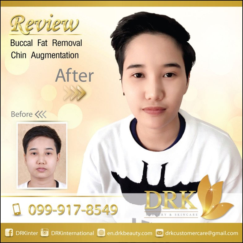 Kpop Slim Cheeks Buccal Fat Removal and Chin Augmentation by Dr. Kolawach