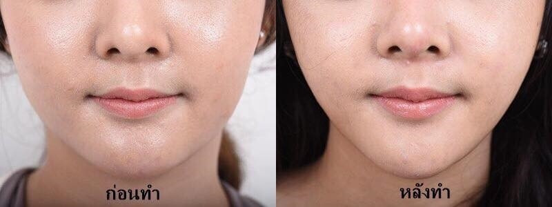 VShape face