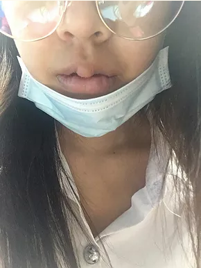 lip surgery