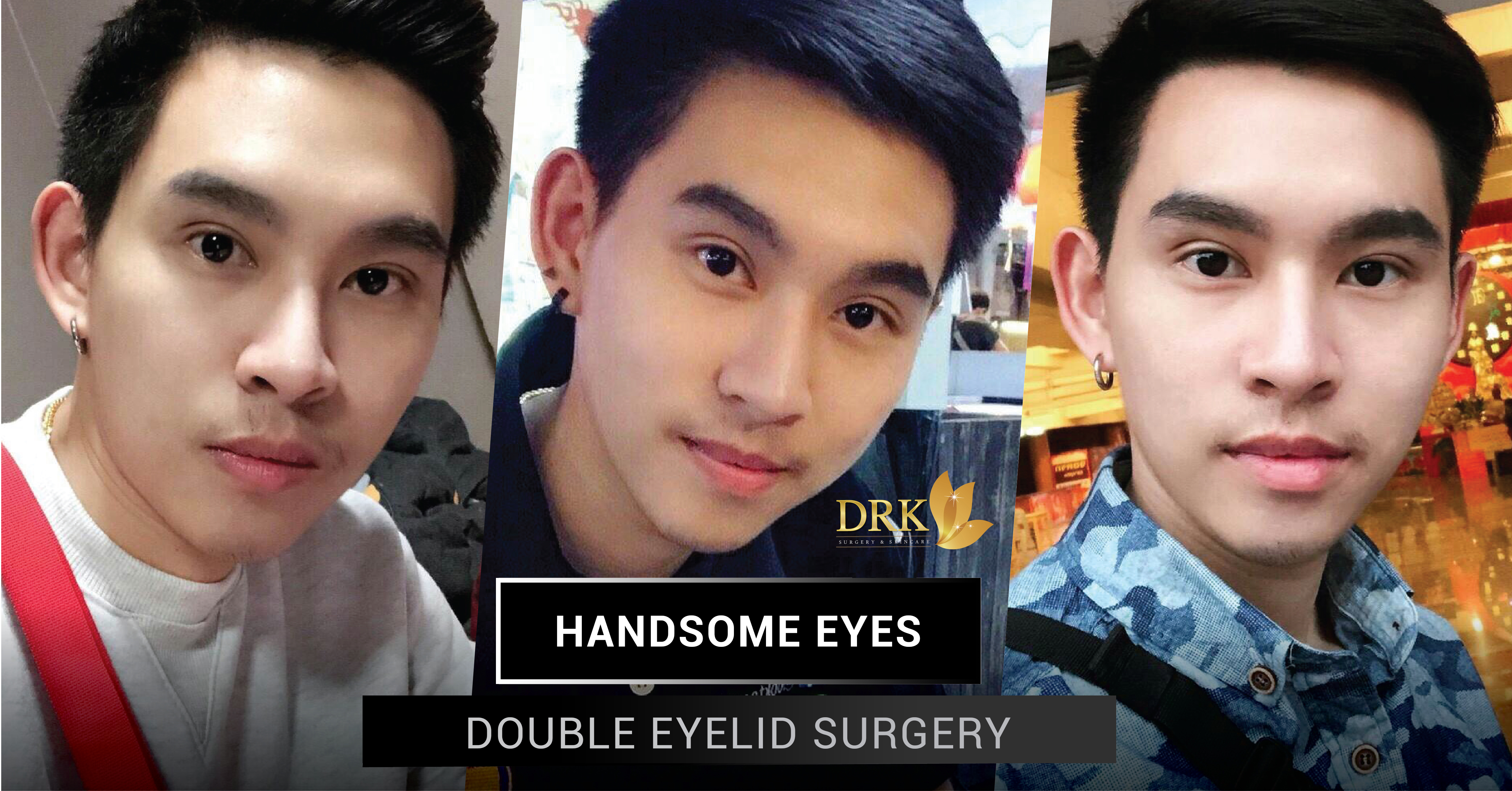 male double eyelid surgery