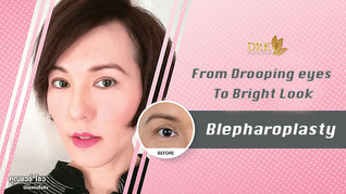 Blepharoplasty made me look 10 years younger!