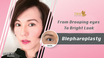 Blepharoplasty made me look 10 years younger!