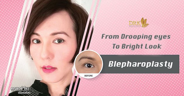 Double Eyelid Blepharoplasty
