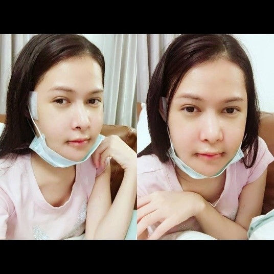 Jaw Surgery