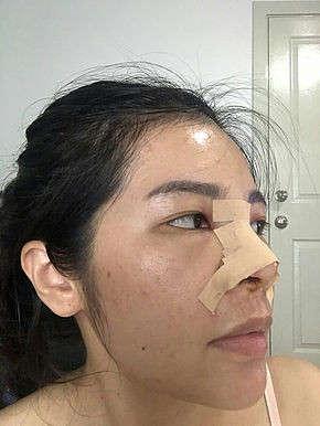 Revision Rhinoplasty