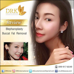 Double eyelid surgery and Buccal Fat Removal with Dr. Kolawach