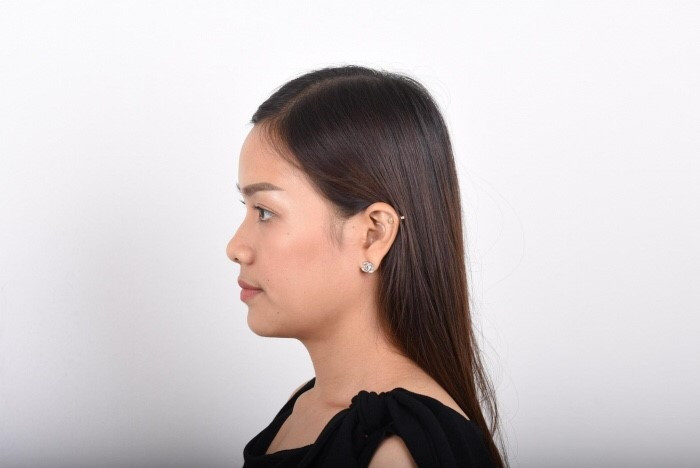 rhinoplasty nose