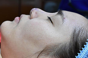 Revision Rhinoplasty