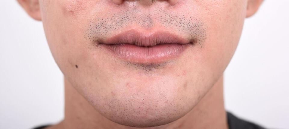 lip reshape