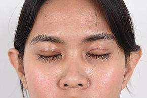 Double Eyelid surgery