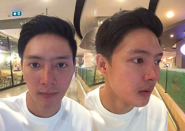 Rhinoplasty Nose