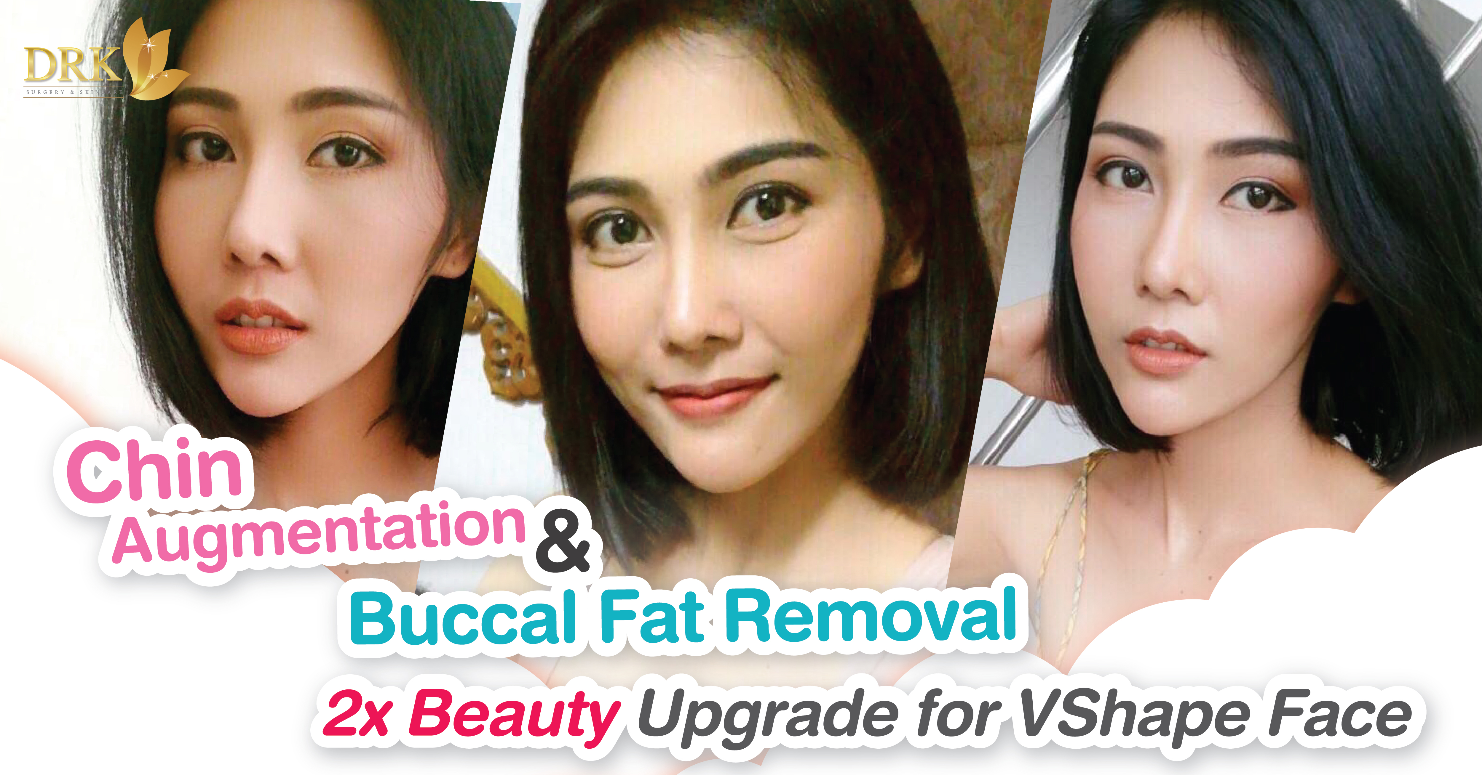 How Vice Ganda Achieved The V Shaped Face Belo Medical Group