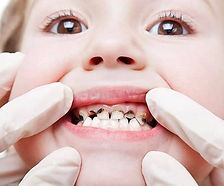 lechenie-kariesa-molochnih-zubov