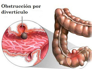 Diverticulite e Doença Diverticular do Cólons