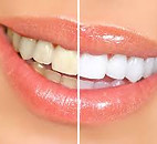 whitening.jpg