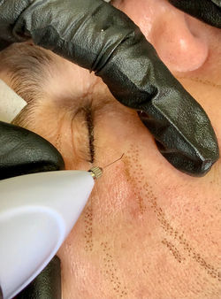 неоперативна блефаропластика и плазма лифт