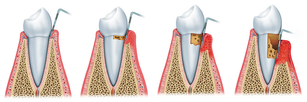 doença periodontal