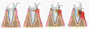 doença periodontal