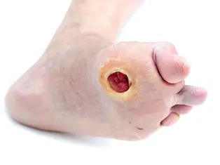 Diabetic Foot Ulcer