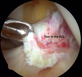 Torn ACL arthroscopy