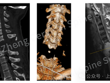 Chinese doctors save patient with rare cervical spine injury
