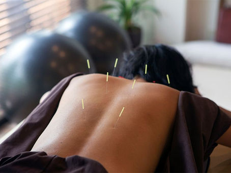 The healing of Eastern Medicine: Acupuncture