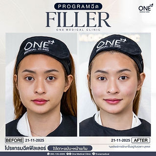 รีวิว BF-AF เชียงใหม่.jpg