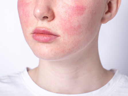 Rosacea