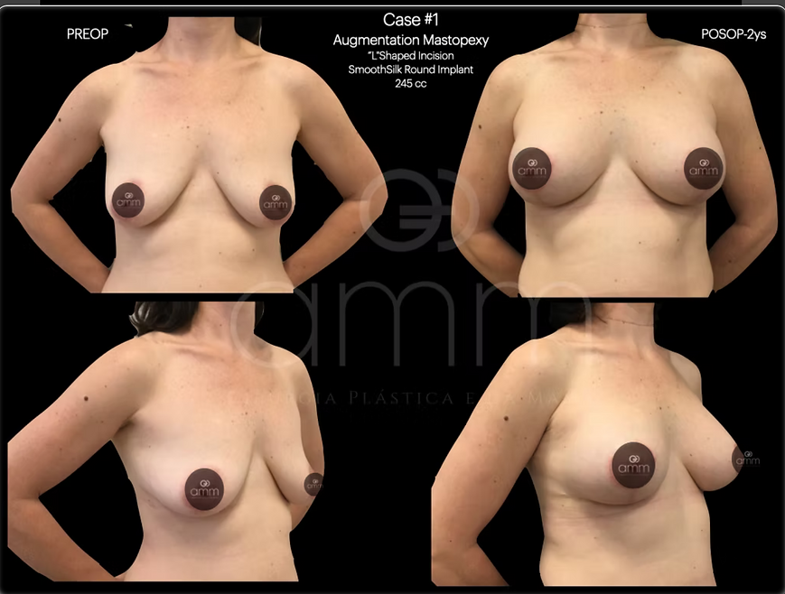 Pexia Protese de Silicone Dr. Alexandre Munhoz Prof. Alexandre Mendonça Munhoz Mamoplastia redutora Redução de mama Hipertrofia mamária mamas grandes Ptose mamária reduction mammoplasty Mastopexia Breast Augmentation Silicone Reconstrução Mamária Breast Reconstruction Clinica AMM Cirurgia Plástica