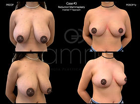 Breast Augmentation Reduction Breast Dr. Alexandre Mendonça Munhoz Dr. Alexandre Munhoz AMM Clinica Protese de Mama Mastopexia Silicone Explantation BII ASIA Syndrome