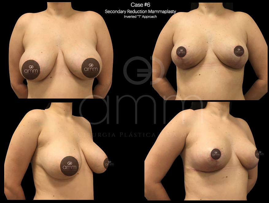 Dr. Alexandre Munhoz Prof. Alexandre Mendonça Munhoz Prótese de Mama Mastopexia Breast Augmentation Silicone Reconstrução Mamária Breast Reconstruction Clinica AMM Cirurgia Plástica Mamoplastia Redutora Reduction Mammoplasty Munhoz