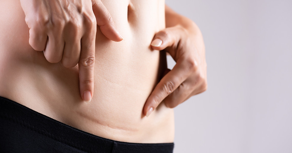 Closeup of woman showing on her belly dark scar from a cesarean section. Healthcare concep