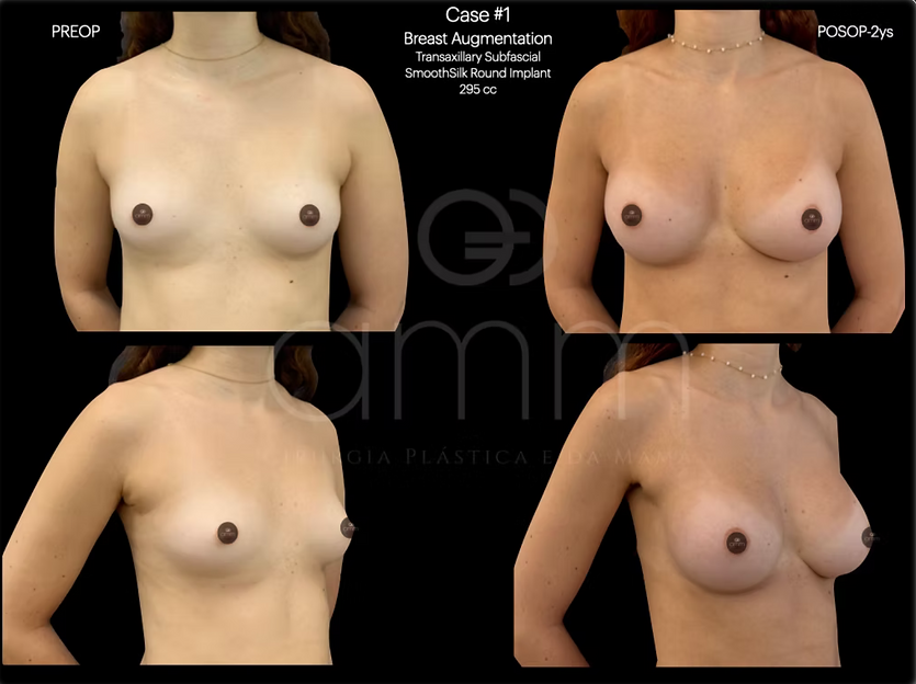 Pexia Protese de Silicone Dr. Alexandre Munhoz Prof. Alexandre Mendonça Munhoz Mamoplastia redutora Redução de mama Hipertrofia mamária mamas grandes Ptose mamária reduction mammoplasty Mastopexia Breast Augmentation Silicone Reconstrução Mamária Breast Reconstruction Clinica AMM Cirurgia Plástica
