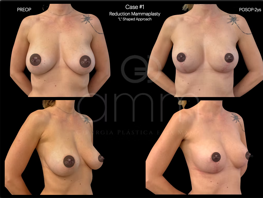 Pexia Protese de Silicone Dr. Alexandre Munhoz Prof. Alexandre Mendonça Munhoz Mamoplastia redutora Redução de mama Hipertrofia mamária mamas grandes Ptose mamária reduction mammoplasty Mastopexia Breast Augmentation Silicone Reconstrução Mamária Breast Reconstruction Clinica AMM Cirurgia Plástica