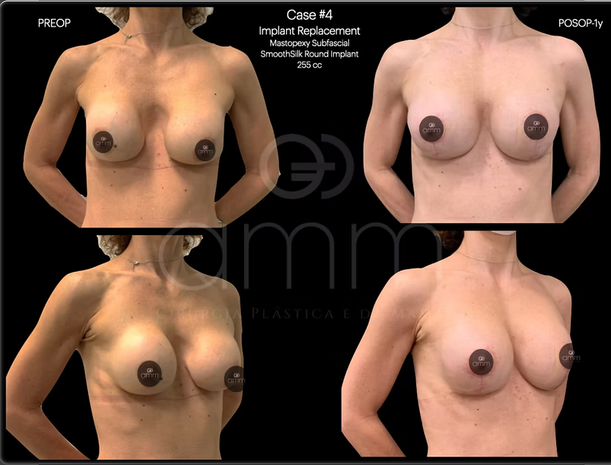 Dr. Alexandre Munhoz Prof. Alexandre Mendonça Munhoz Prótese de Mama Mastopexia Breast Augmentation Silicone Reconstrução Mamária Breast Reconstruction Clinica AMM Cirurgia Plástica Pexia Hibrida Enxerto de Gordura Hybrid Breast Augmentation Fat Grafting