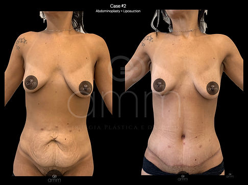 Dr. Alexandre Munhoz Prof. Alexandre Mendonça Munhoz Prótese de Mama Mastopexia Breast Augmentation Silicone Reconstrução Mamária Breast Reconstruction Clinica AMM Cirurgia Plástica Abdominoplastia Plástica de Abdome Dermolipectomia Diástase