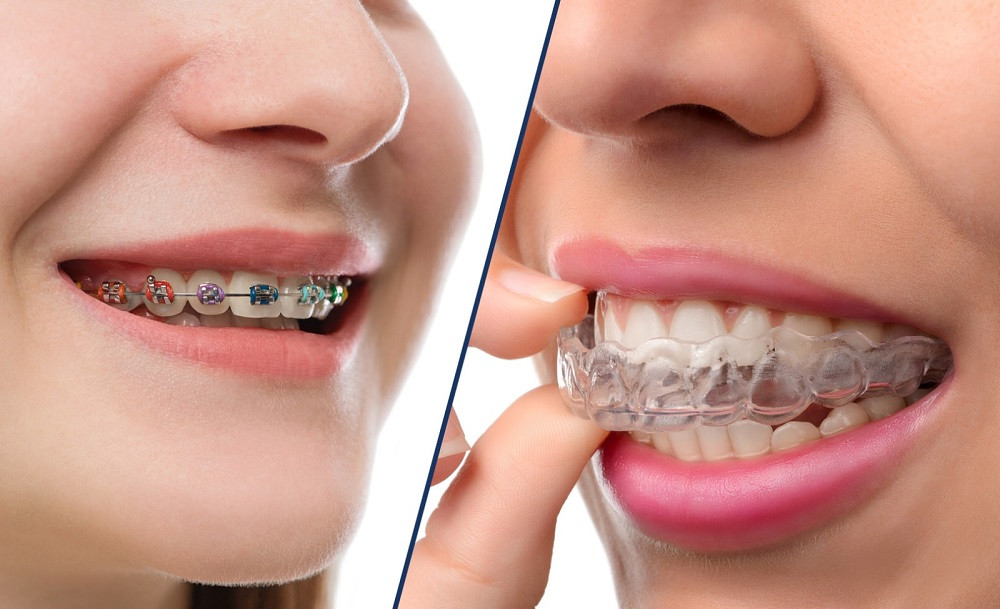 Dental Invisalign is a popular modern teeth straightening solution