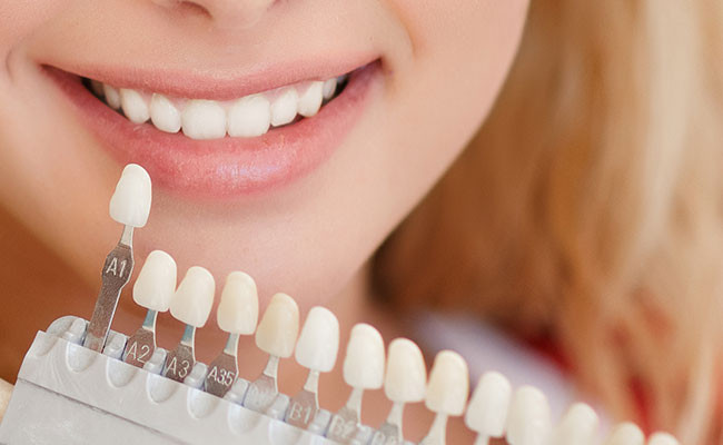 Veneers are a popular for their customization.