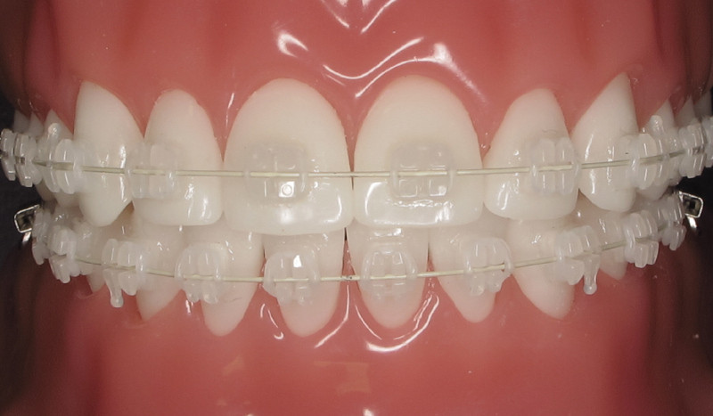 Monomax Orthodontic Braces