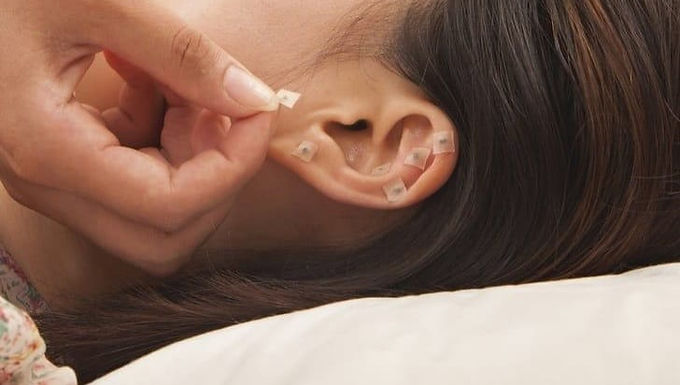 Auriculoterapia