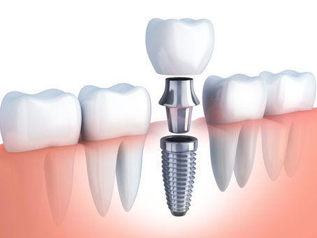 Transform Your Smile with Dental Implants at Vedha Dental