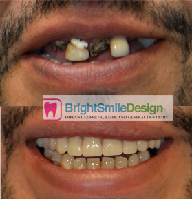 Dental Implants, before and after
