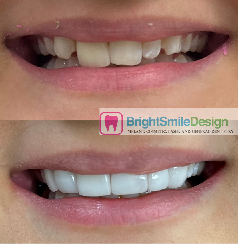 Dental Veneers before and after 6 front.JPG